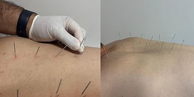 AKUPUNKTUR TEDAVİSİ İÇİN ÇİN'E GİTMENİZE GEREK YOK.