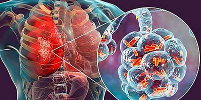 UŞAK SAĞLIK MÜDÜRLÜĞÜ DÜNYA ZATÜRRE GÜNÜ DOLAYISIYLA BİR BİLDİRİ YAYINLADI.